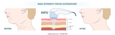 HIFU（ハイフ、高密度焦点式超音波）について