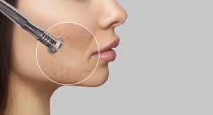 ミクロダーマブレーション（Microdermabrasion）について